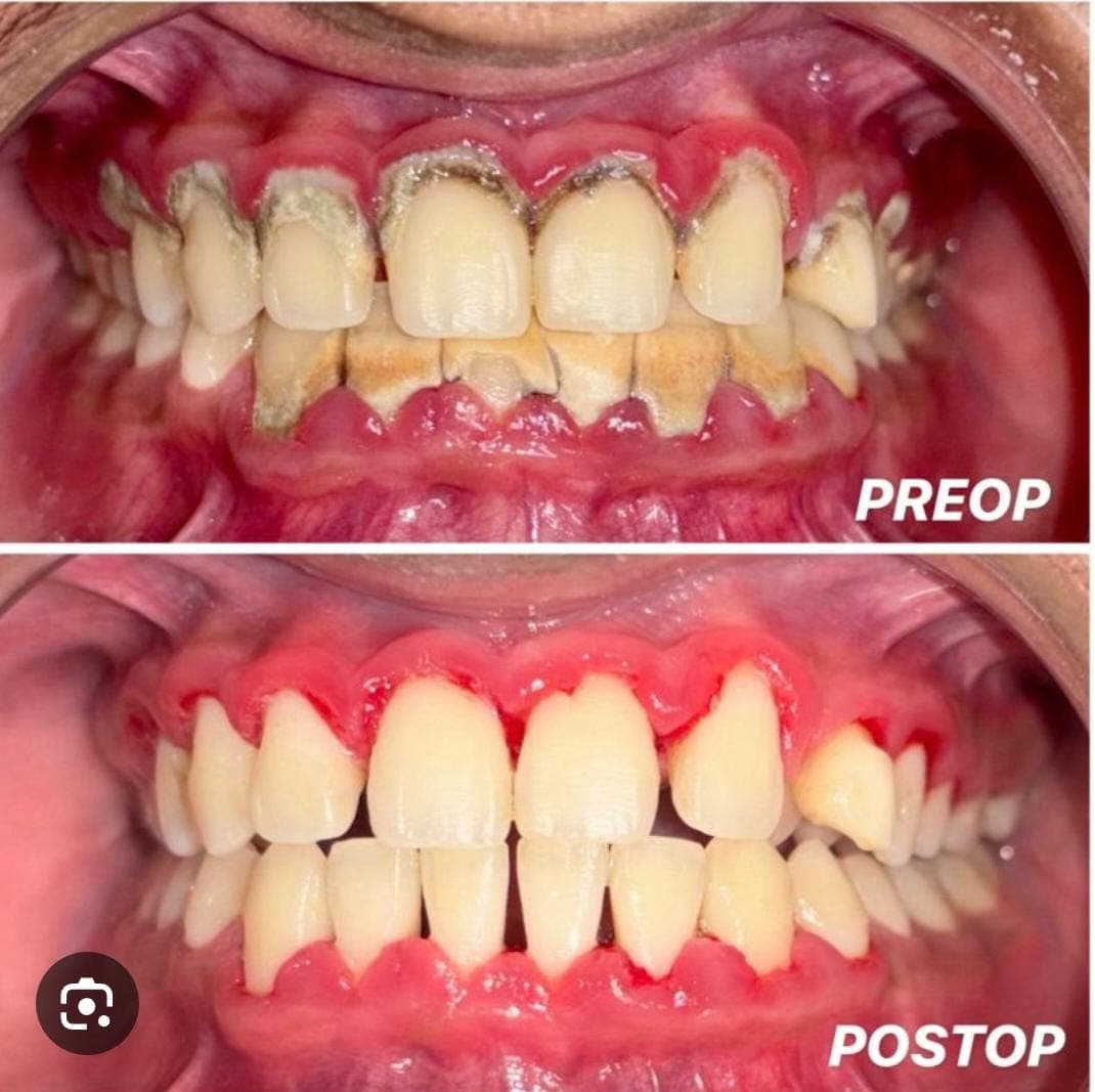 Before and after dental cleaning photos showing removal of thick tartar buildup from inflamed gums.