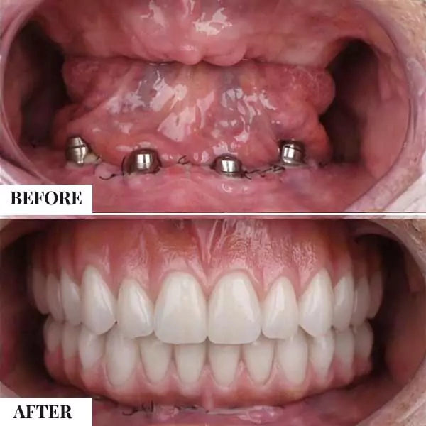 Before and after comparison of dental implants and a full set of white prosthetic teeth.