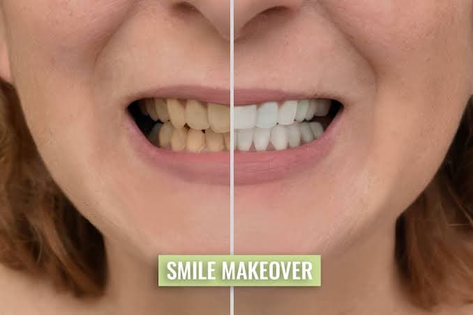 Split-screen comparison of a smile makeover showing yellowed teeth versus bright, whitened teeth.