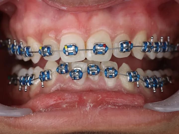Close-up of metal orthodontic braces with blue elastic bands on upper and lower teeth.